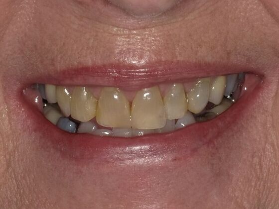 Before crowns and veneers with Dr. Dan