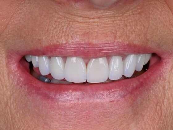 After crowns and veneers with Dr. Dan