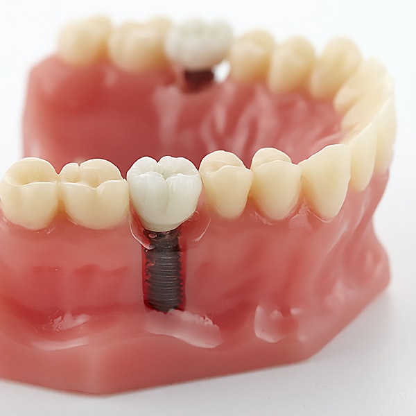 Model of a dental implant and restoration