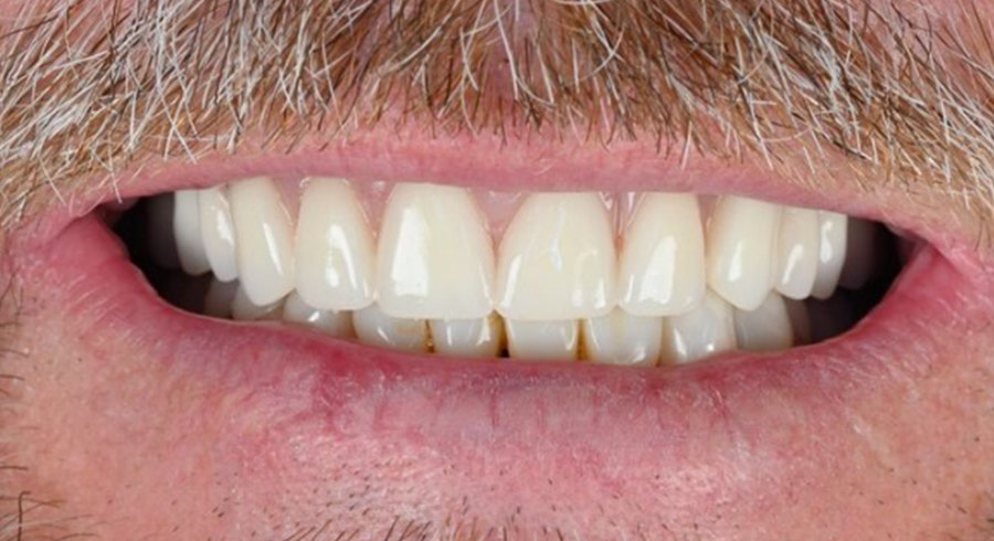 after dental implants