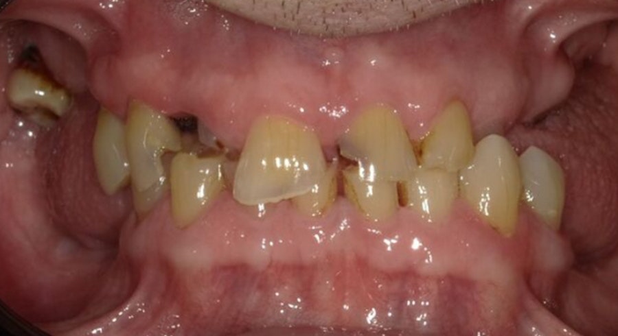 before dental implants