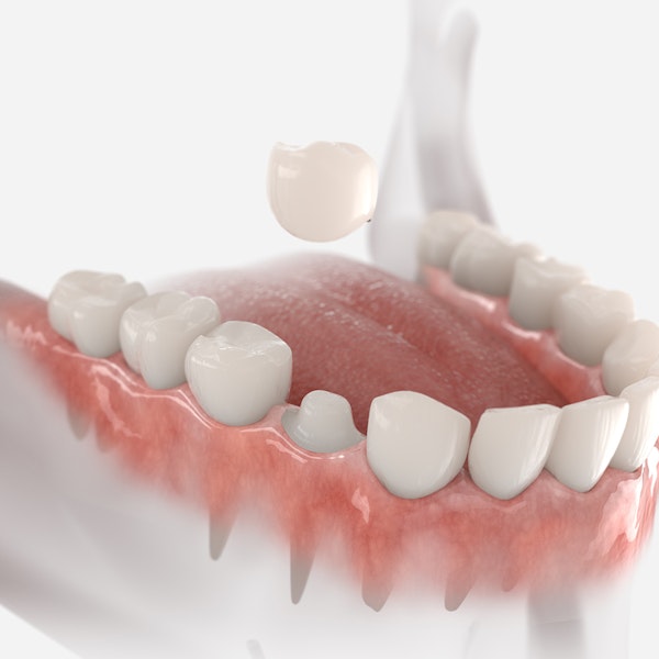 Dental crowns