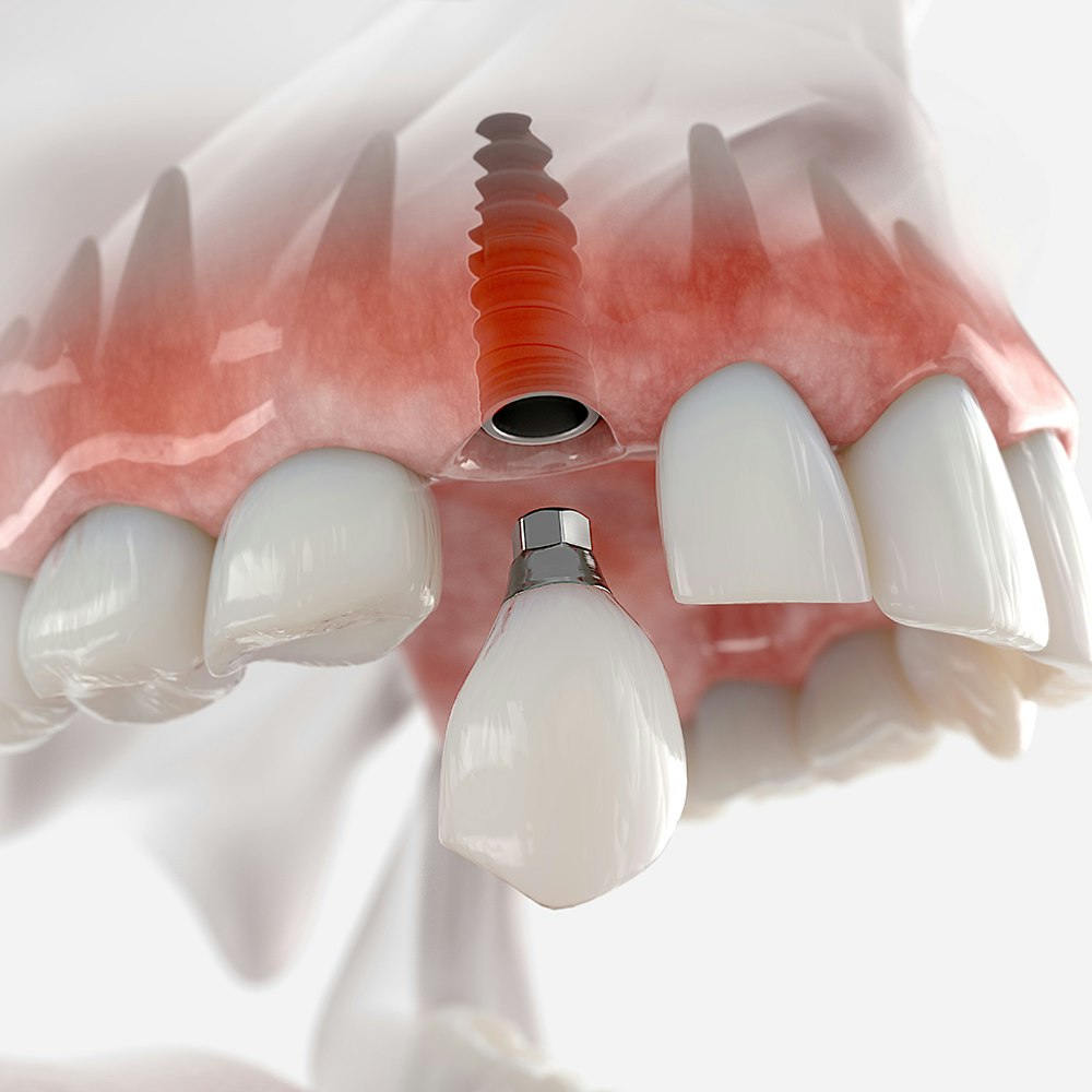Dental implants