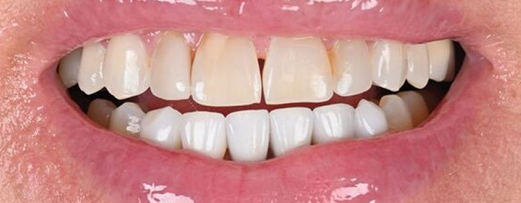 Actual Patient Before Crowns