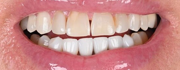 Actual Patient Before Crowns