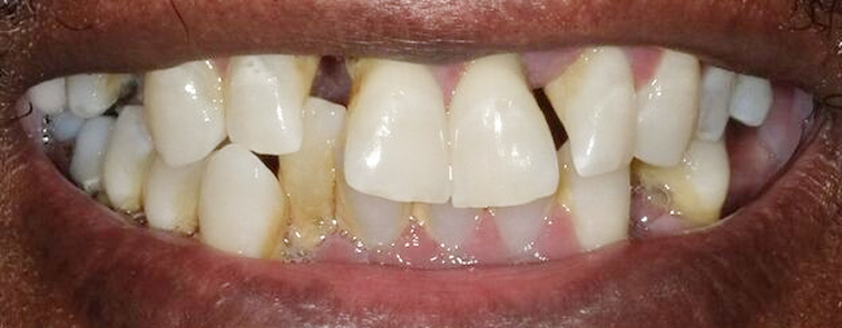 Patient before implants