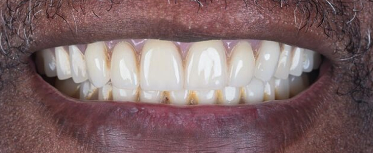 patient afte implants