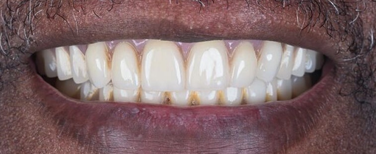 patient afte implants