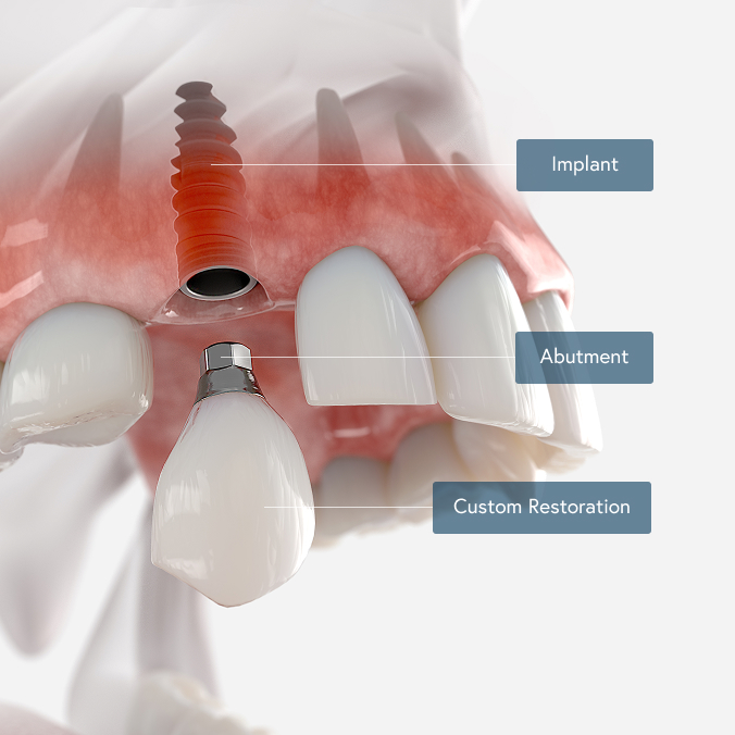 Dental Implants