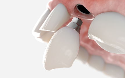 Immediate-Load Implants