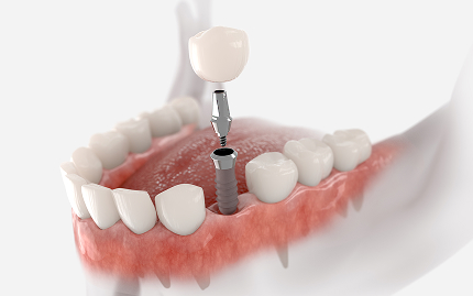 Implant-Supported Crowns
