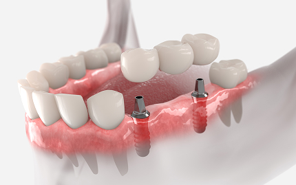 Implant-Supported Bridges