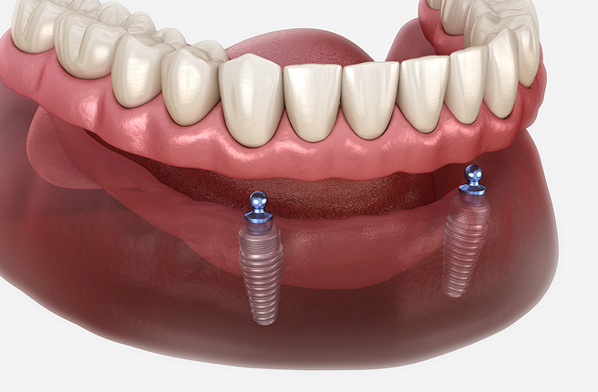 Snap-on Dentures