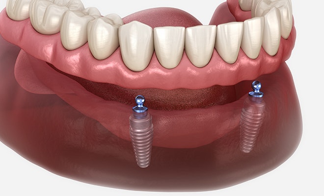 Snap-on Dentures