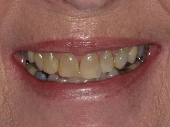 Before dental crowns