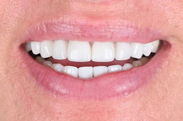 after dental crowns