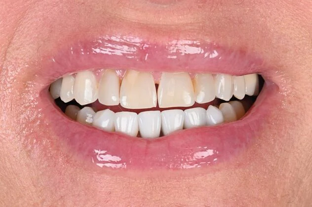 before dental crowns