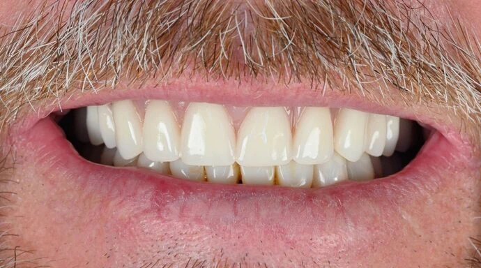 After Dentures