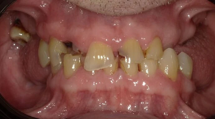 Before Dentures