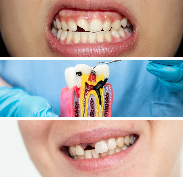 Dental Crown example