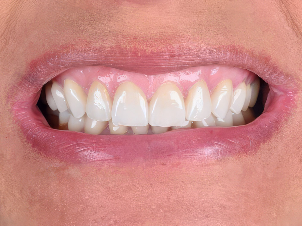 After dental crowns