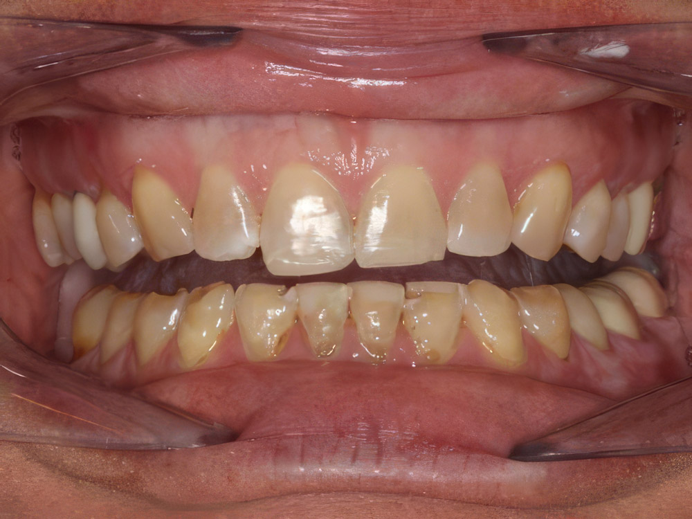 Before dental crowns