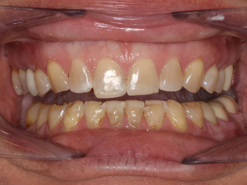 Before dental crowns