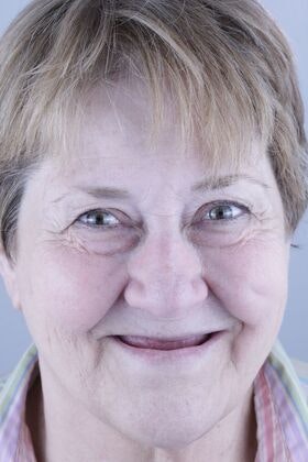 Woman missing most of her teeth along her upper and lower arch.