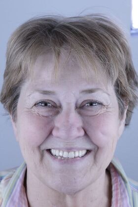 Woman smiling with straight, white teeth after getting all-on-4 implants