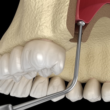 sinus lift illustration