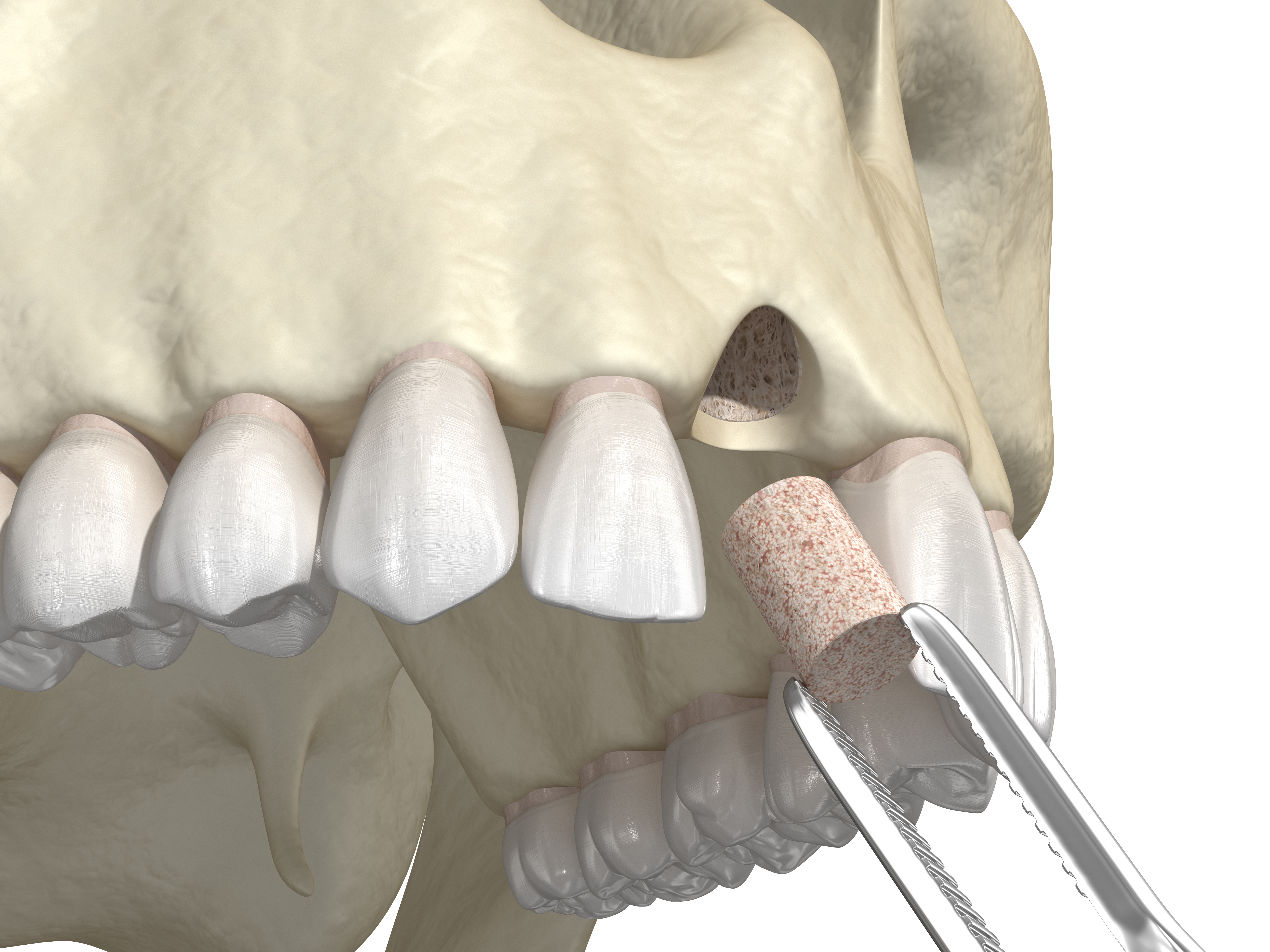 bone graft illustration