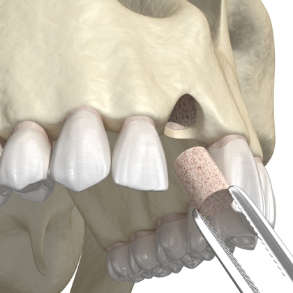 bone graft illustration