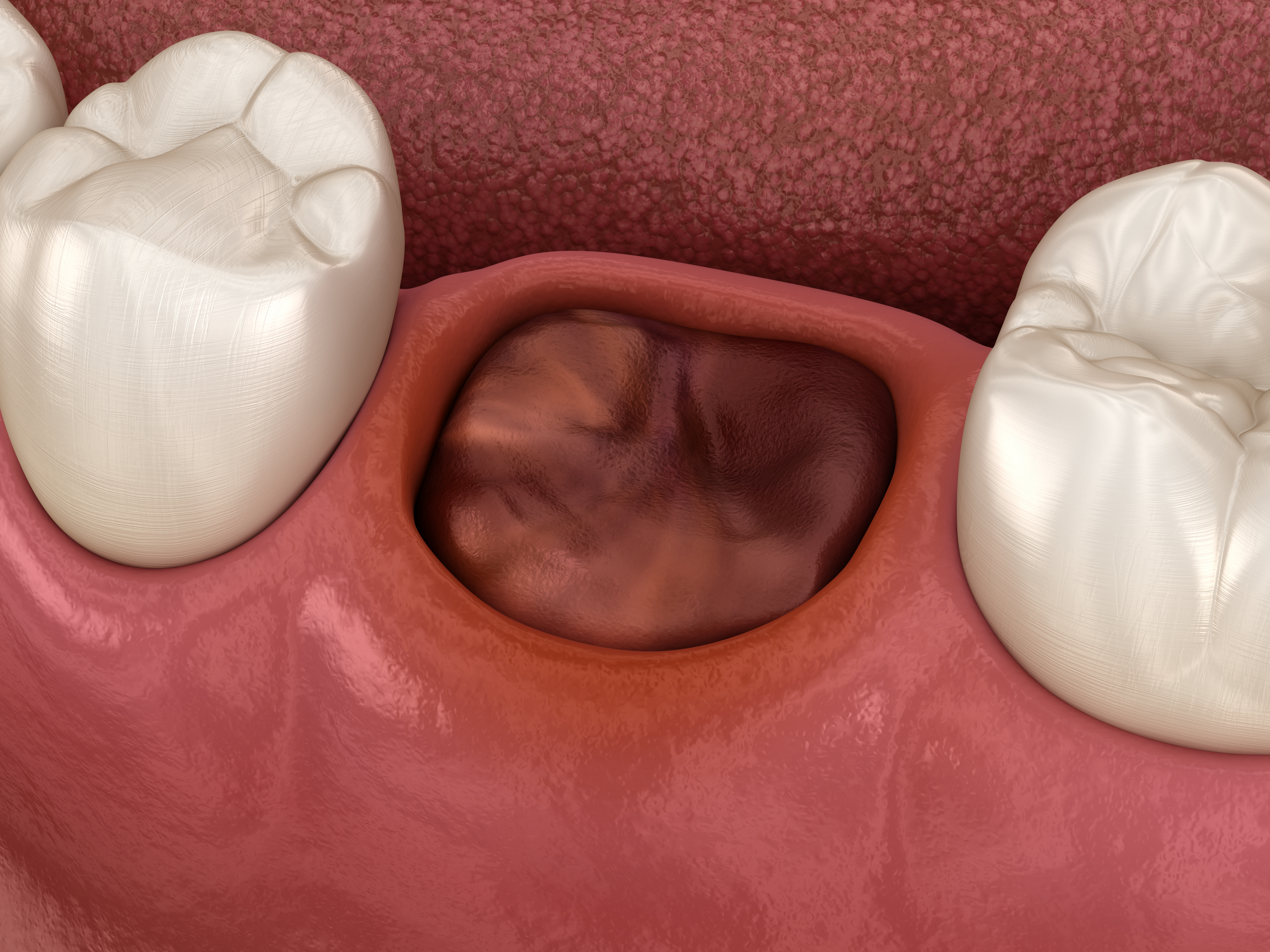 illustration of gums with a missing tooth