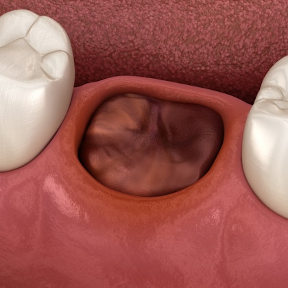 illustration of gums with a missing tooth