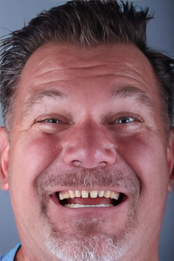 Loval Dental patient before dental crowns