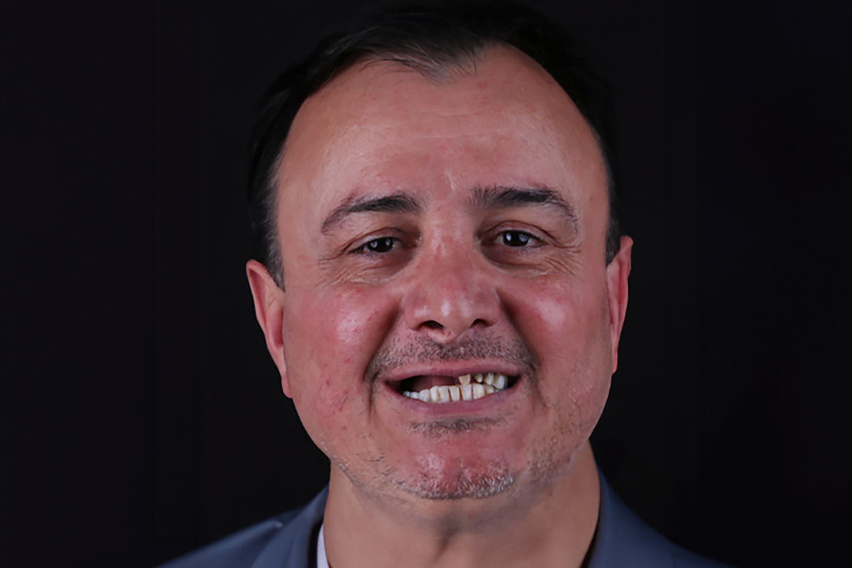 Patient before implants