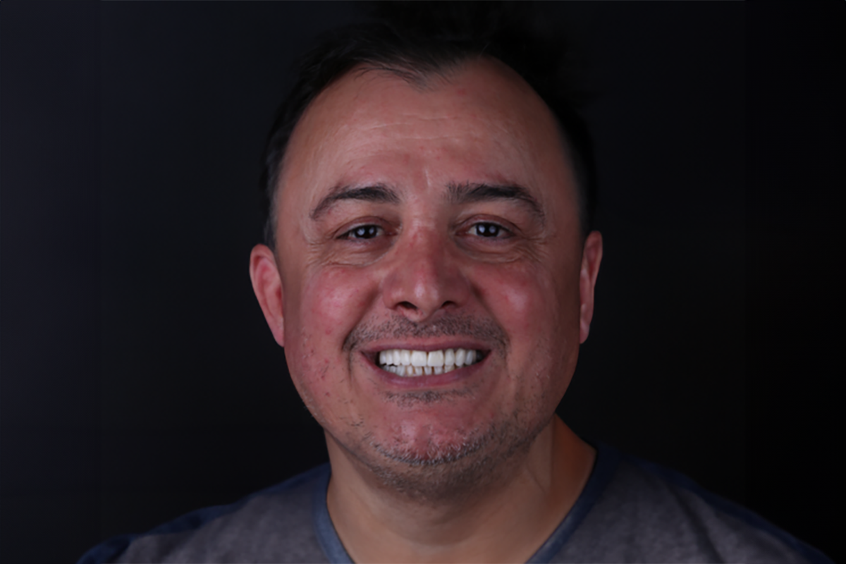 Patient after implants