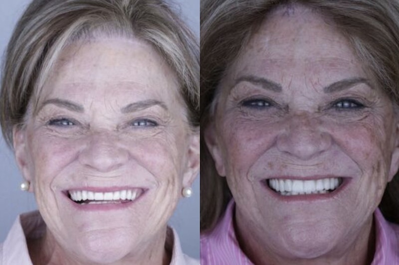 Candace before and after All-on-4 implants