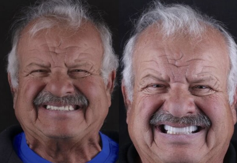 Sam before and after all-on-6