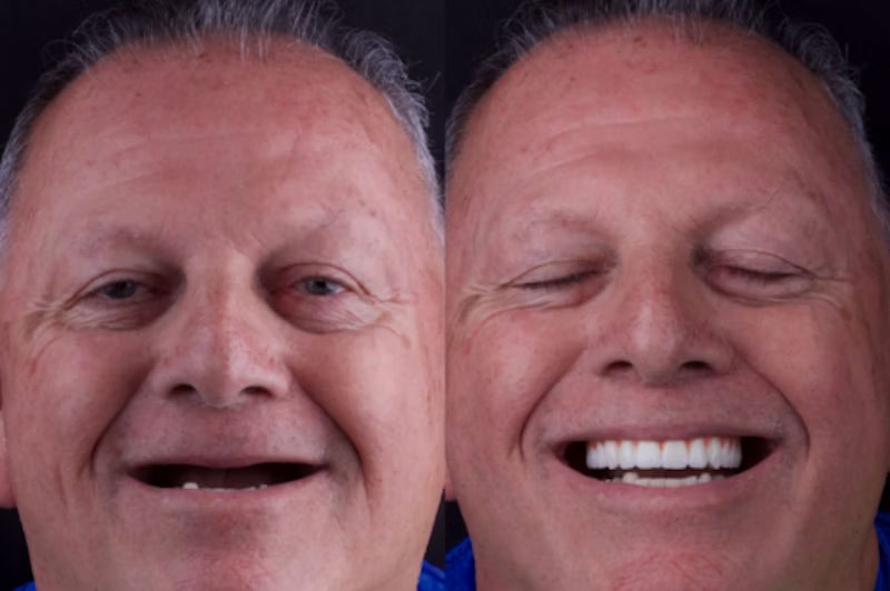 All-on-6 before and after