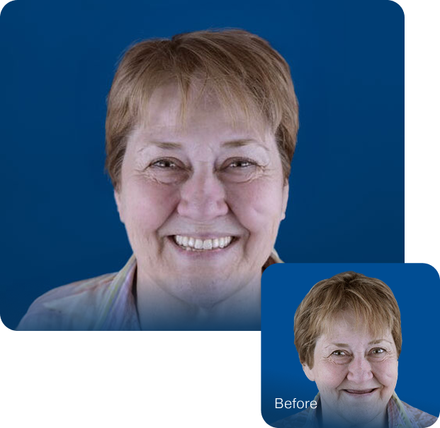 Before and after full mouth reconstruction