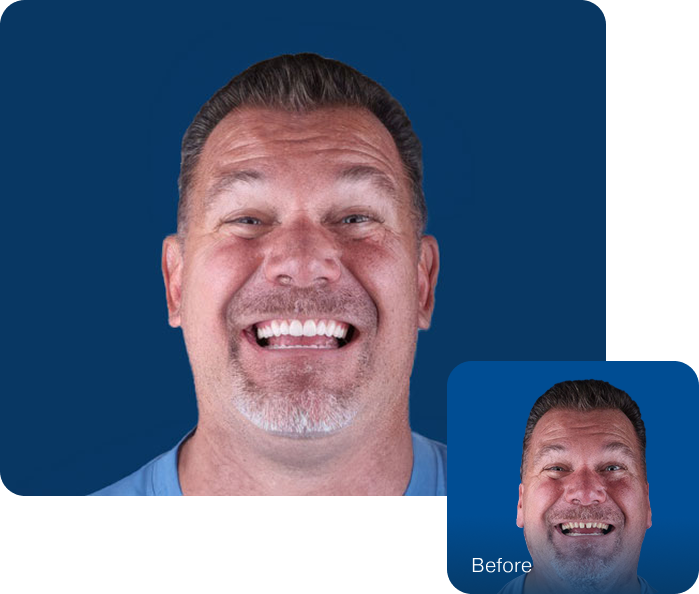 before and after dental crowns