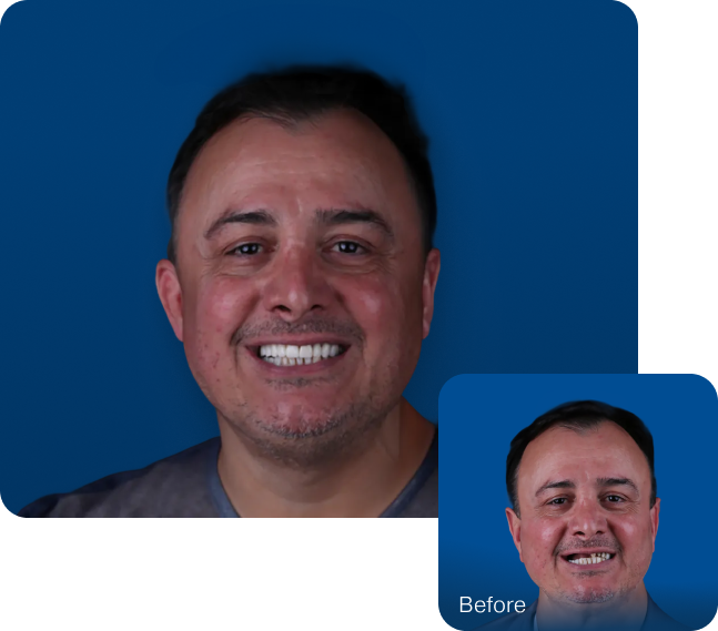 patient before and after dental implants