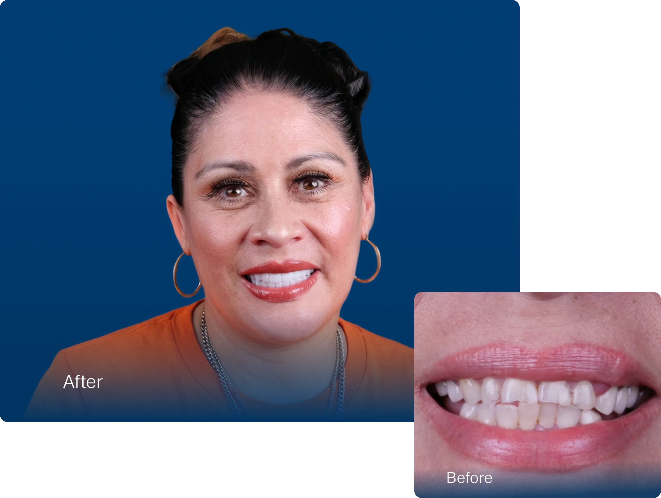 patient before and after dental implants