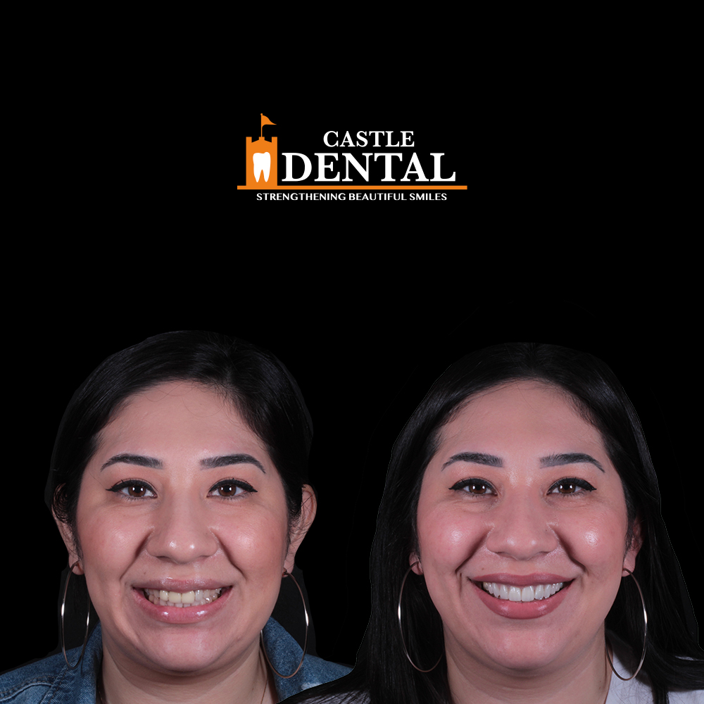 Young woman patient at Castle Dental, before and after veneers