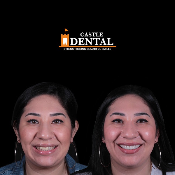 Young woman patient at Castle Dental, before and after veneers