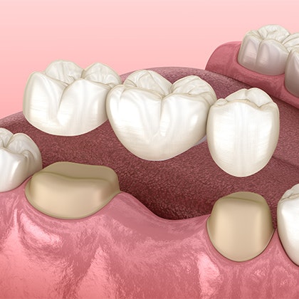 Traditional dental bridge