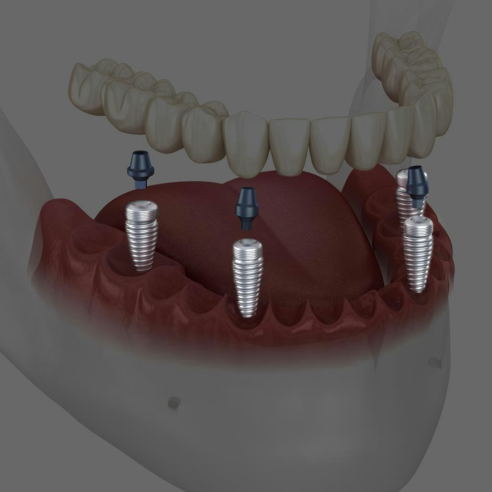 Dental Implants