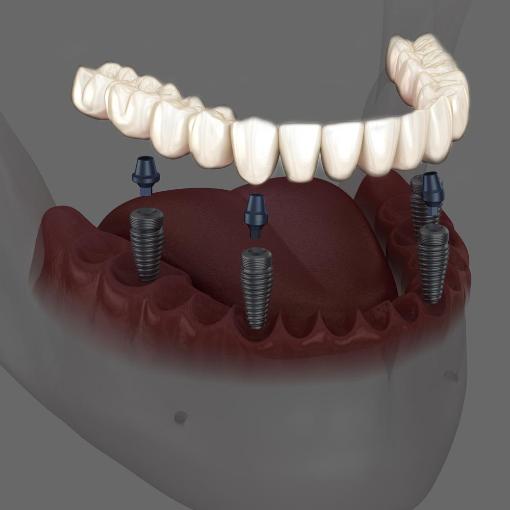 Allon4 Dental Implants Los Algodones, MX Castle Dental Inc