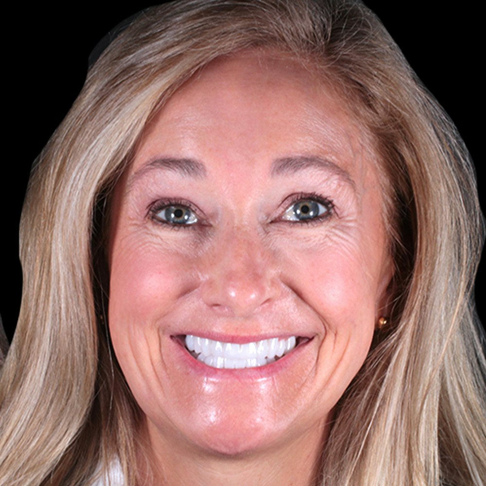 a woman smiling after having a smile makeover